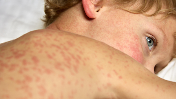 America’s Measles Outbreak: What You Need to Know.