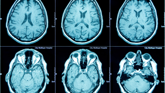 New Method Makes Brain Imaging Research More Accessible for Psychiatric Studies.