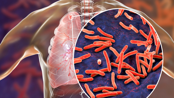 New DNA Analysis Provides First Accurate Tuberculosis Genome.